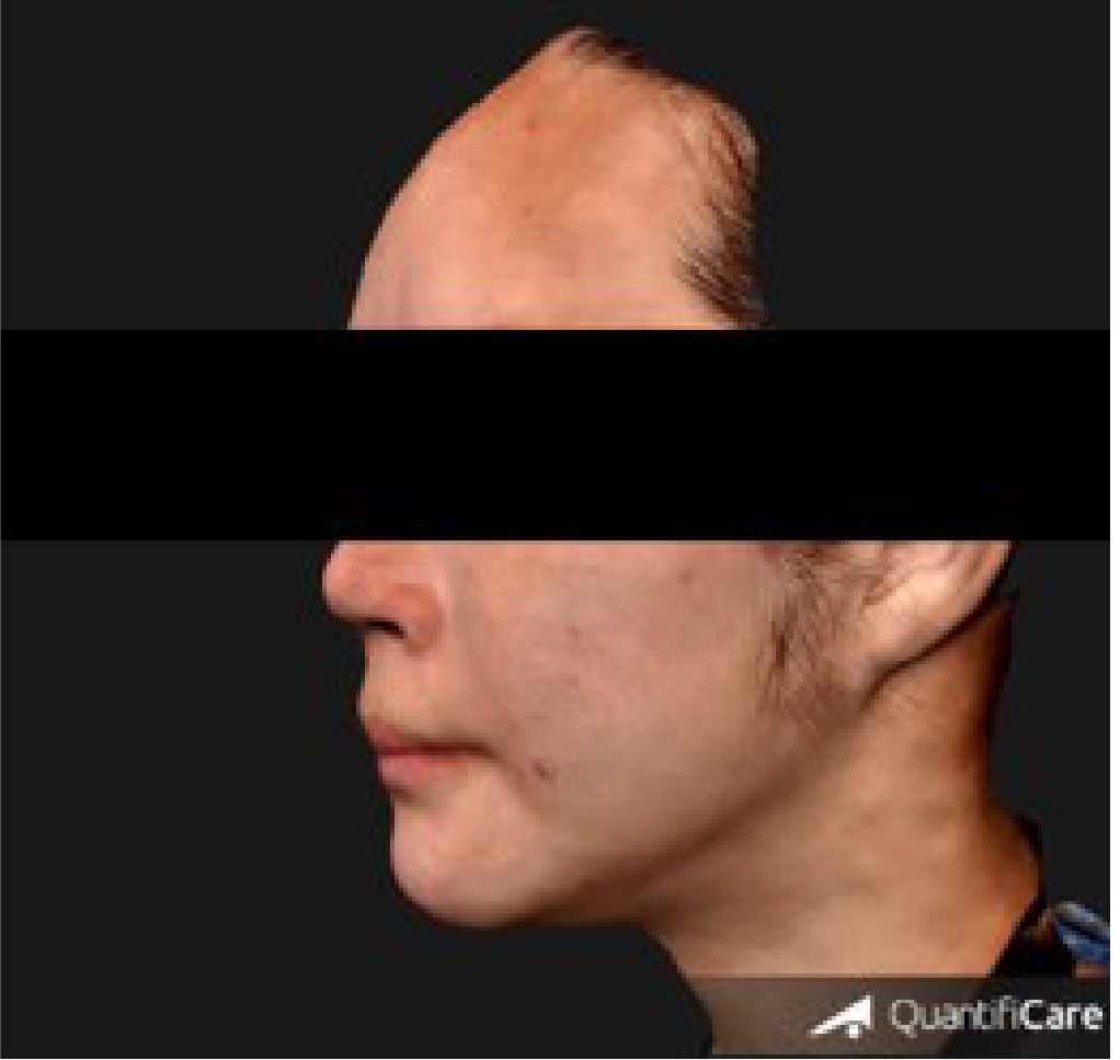 After 1.5 Month