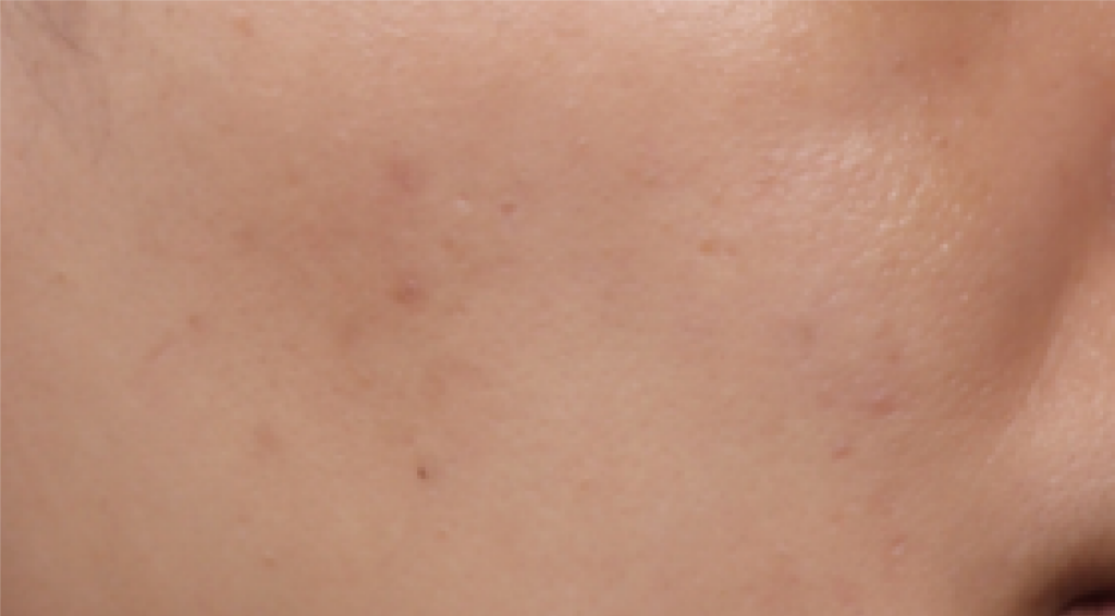After 1 Month