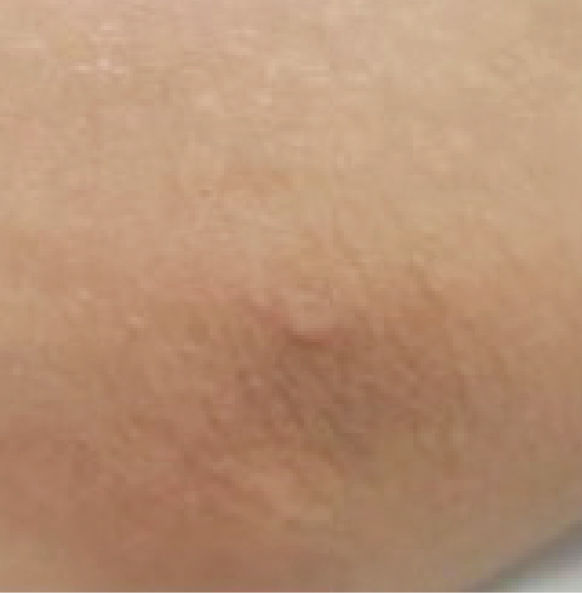 濕疹 2個月
