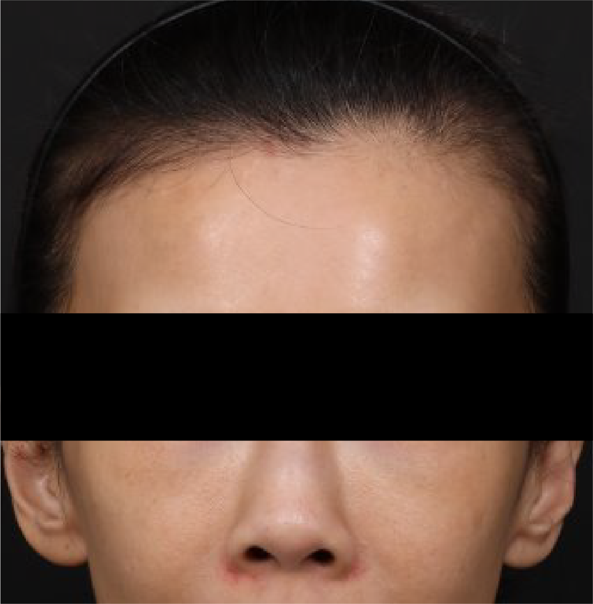 女性髮量正面 – After1