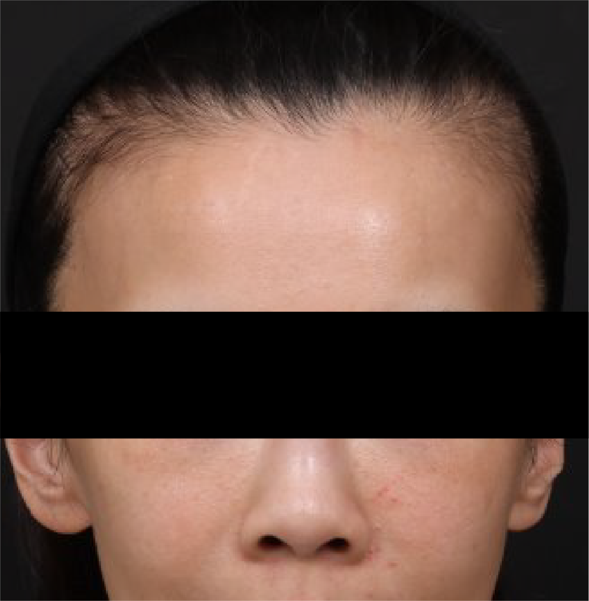 女性髮量正面 – Before