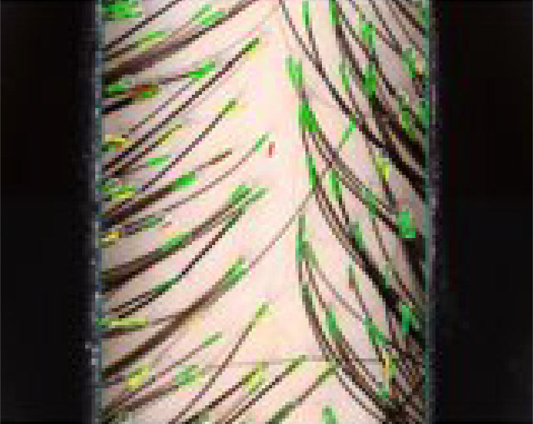 髮根密度 Case 2 – 1.5Month