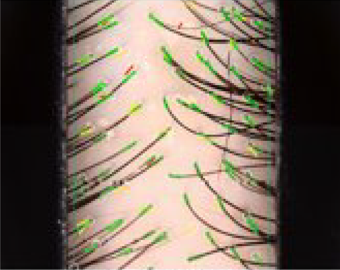 髮根密度 Case 2 – 1Month