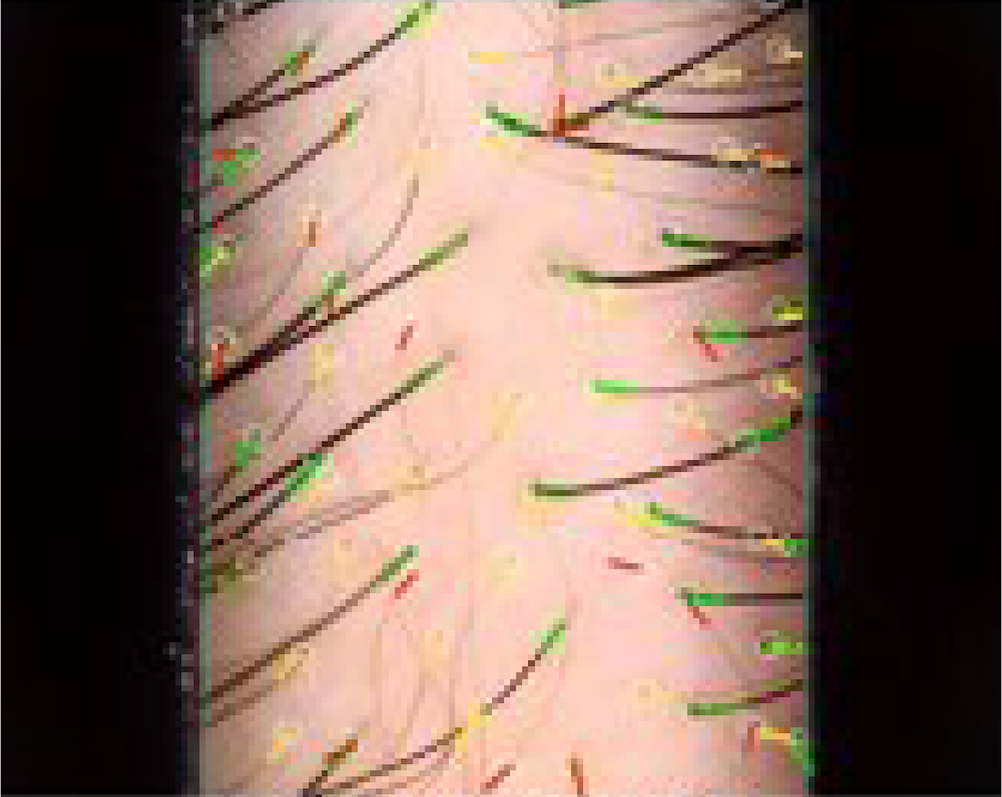 髮根密度 Case 2 – Before